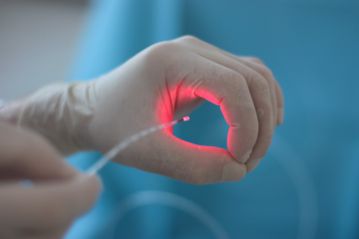 Лазерное иссечение анальной трещины